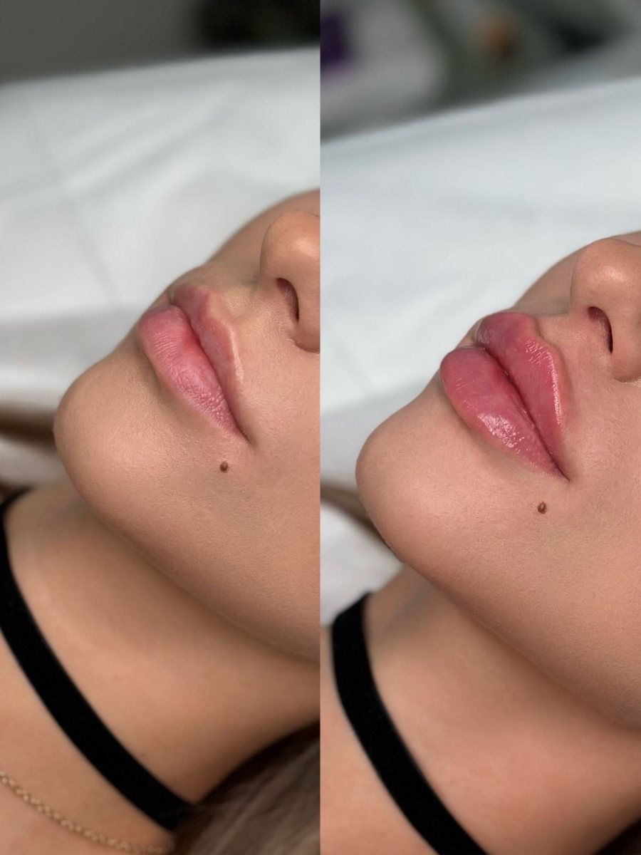 Aumento de labios