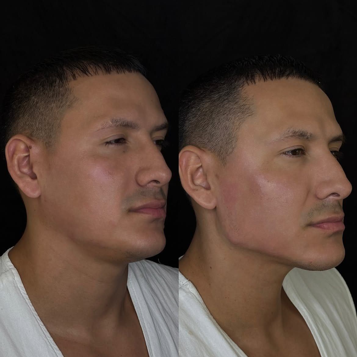 Armonización mandibular