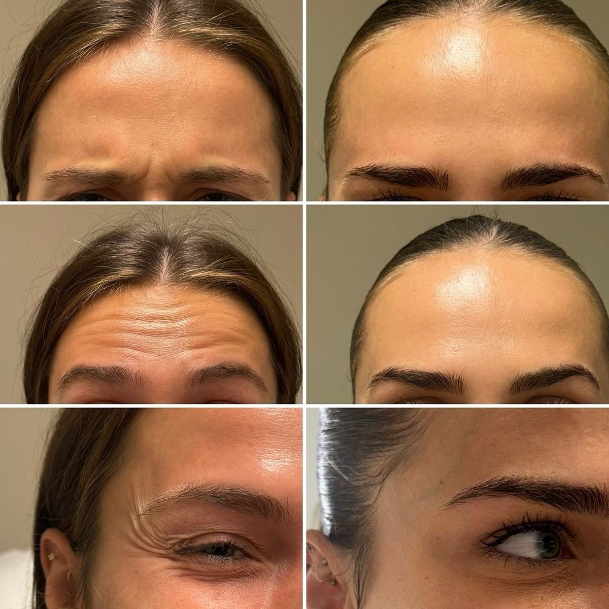 Tratamiento con Toxina Botulínica