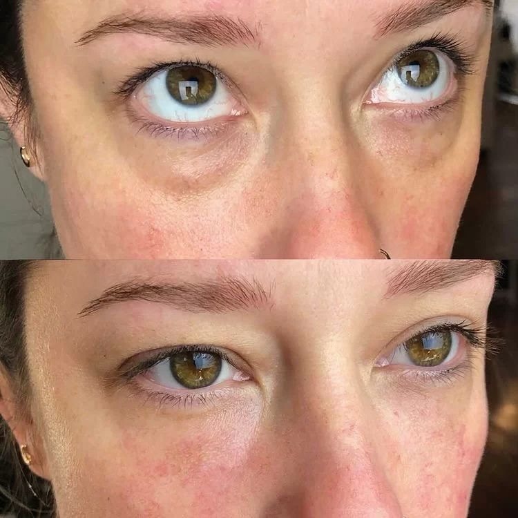 Tratamiento de ojeras