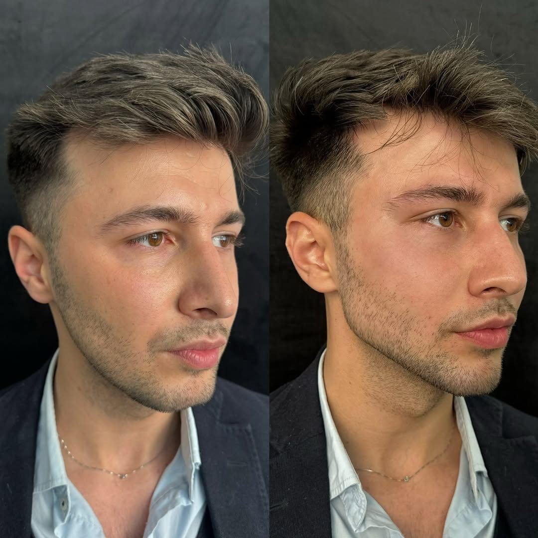 Masculinización facial