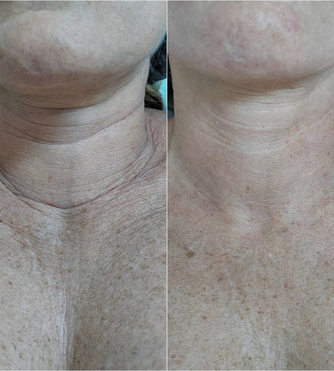 Nefertiti Lift